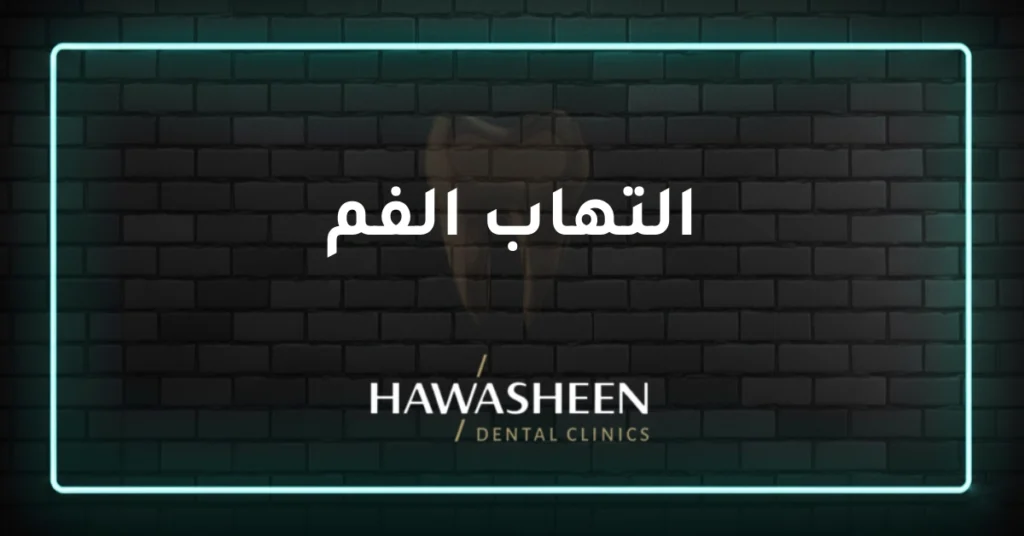 التهاب الفم - Dr Eyad Hawasheen - Hawasheen Dental Clinics