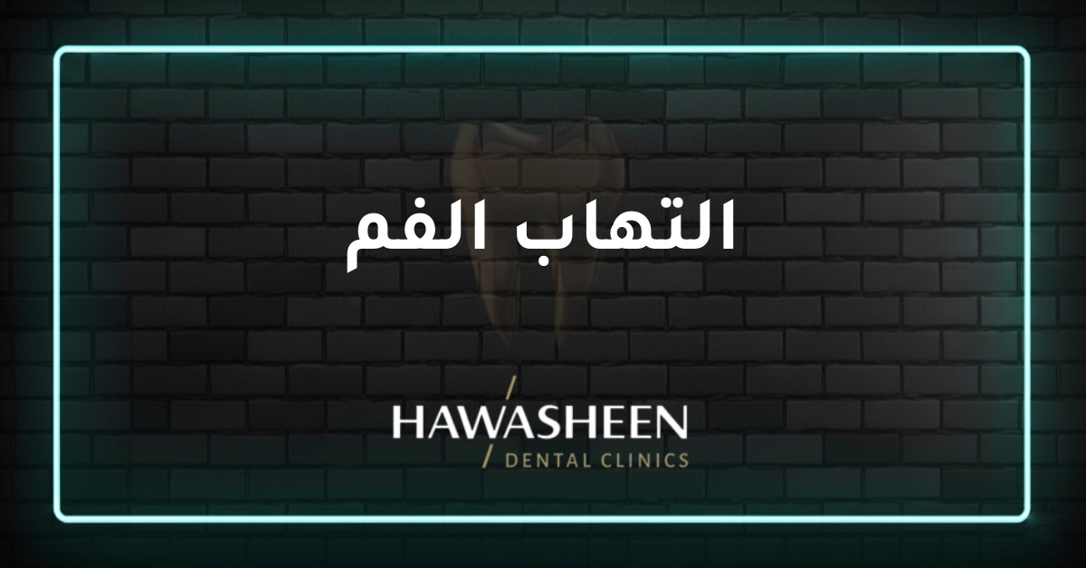 التهاب الفم - Dr Eyad Hawasheen - Hawasheen Dental Clinics