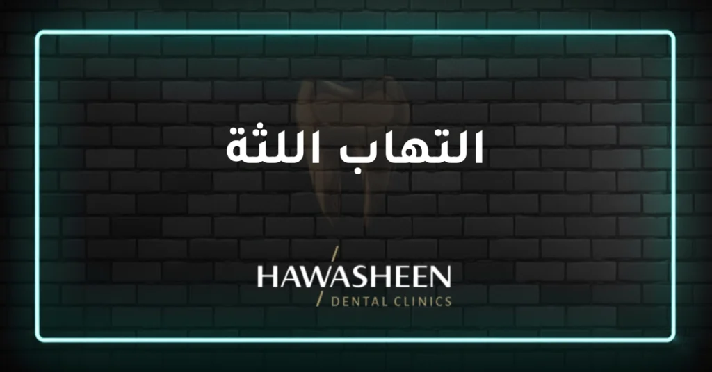 التهاب اللثة - Dr Eyad Hawasheen - Hawasheen Dental Clinics
