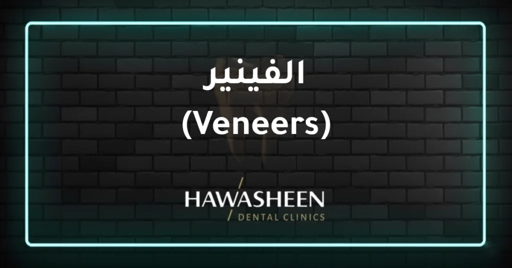 الفينير (Veneers)