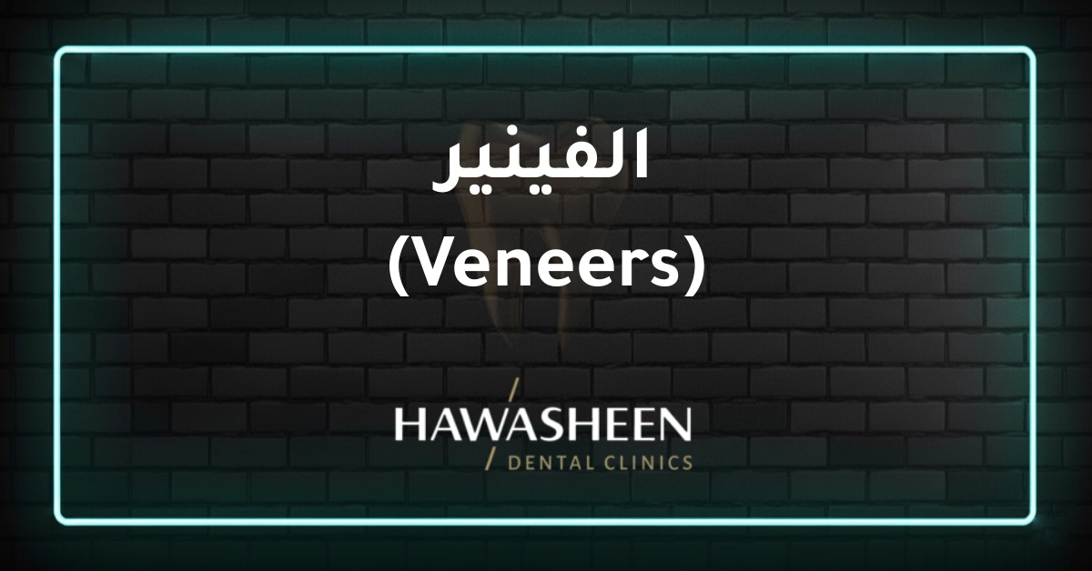 الفينير (Veneers)