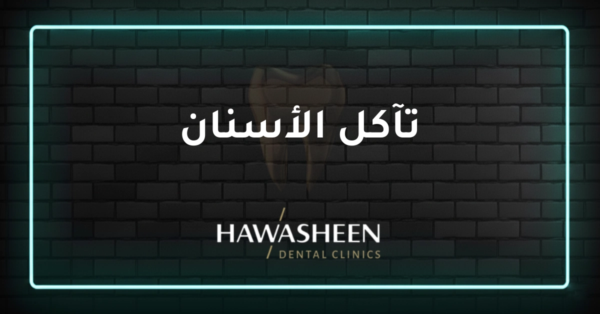 تآكل الأسنان - Dr Eyad Hawasheen - Hawasheen Dental Clinics