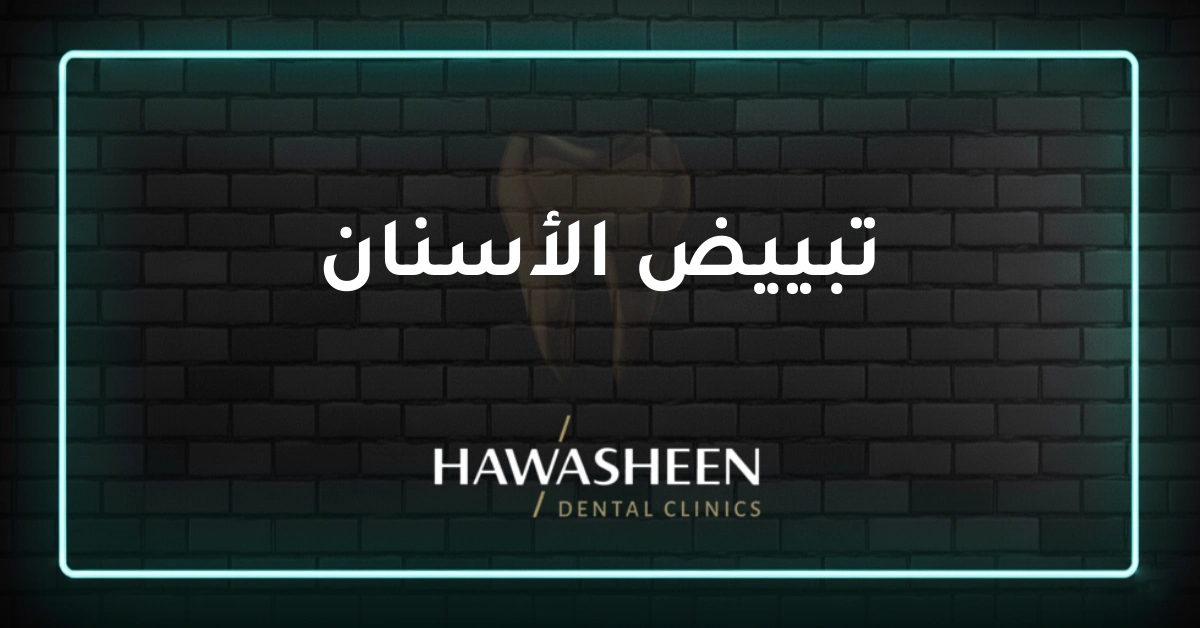 تبييض الأسنان - Dr Eyad Hawasheen - Hawasheen Dental Clinics