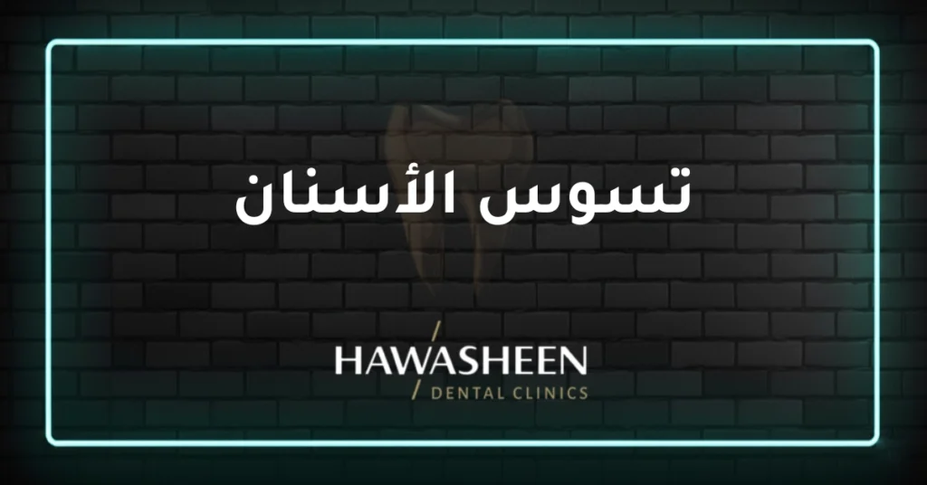 تسوس الأسنان - Dr Eyad Hawasheen - Hawasheen Dental Clinics