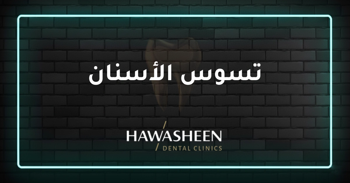 تسوس الأسنان - Dr Eyad Hawasheen - Hawasheen Dental Clinics
