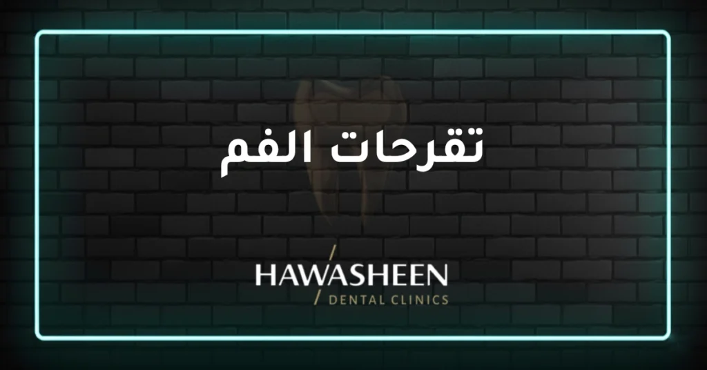 تقرحات الفم - Dr Eyad Hawasheen - Hawasheen Dental Clinics