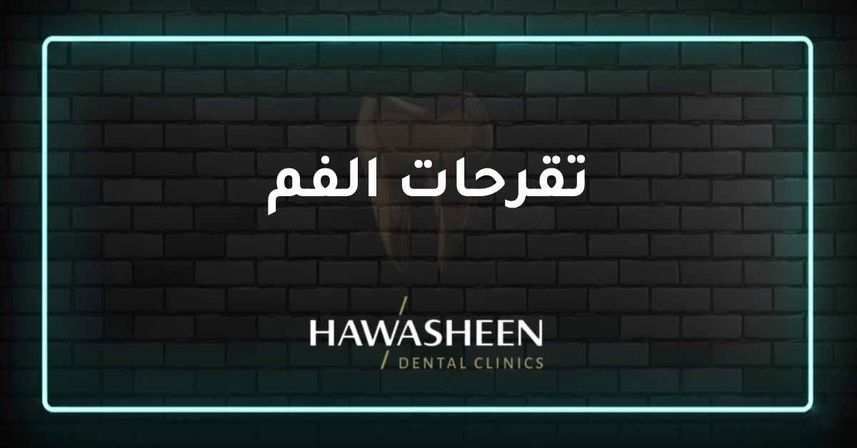 تقرحات الفم - Dr Eyad Hawasheen - Hawasheen Dental Clinics