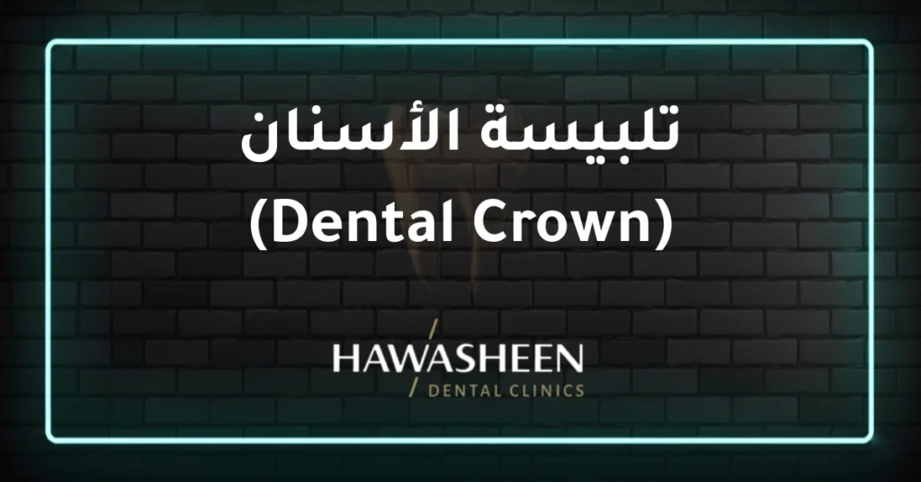 تلبيسة الأسنان (Dental Crown) - Dr Eyad Hawasheen - Hawasheen Dental Clinics