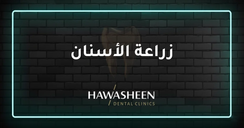 زراعة الأسنان - Dr Eyad Hawasheen - Hawasheen Dental Clinics