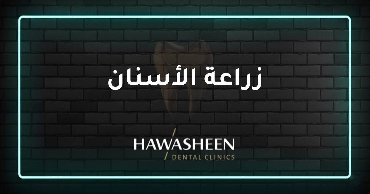زراعة الأسنان - Dr Eyad Hawasheen - Hawasheen Dental Clinics